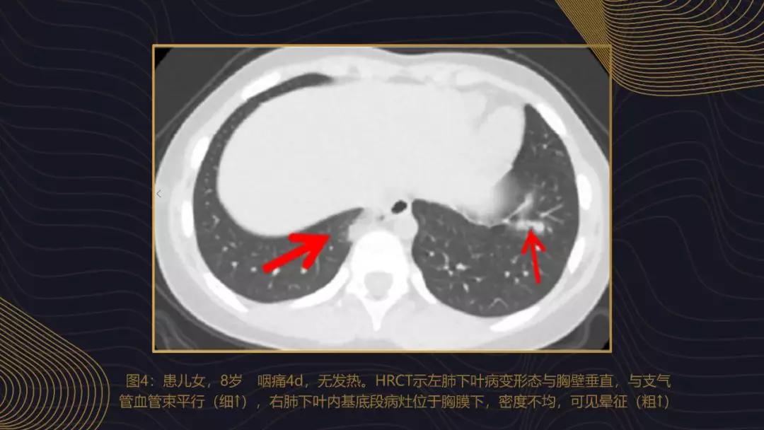 新加坡新冠肺炎最早增长情况分析与探讨